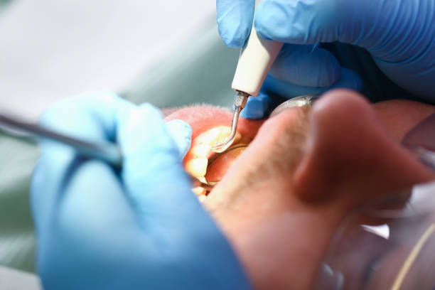 Best Emergency Root Canal Treatment in Lake Catherine, IL